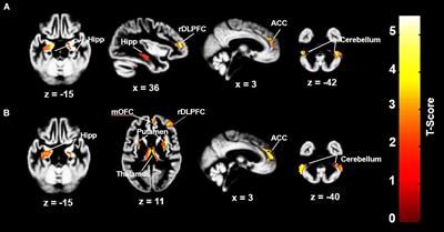 Exploratory Analyses of Cerebral Gray Matter Volumes After Out-of-Hospital Cardiac Arrest in Good Outcome Survivors